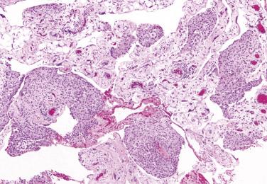 FIG. 15.1, Nodular mesothelial hyperplasia involving omentum.