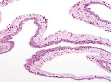 FIG. 15.12, Multilocular peritoneal inclusion cyst with squamous metaplasia.