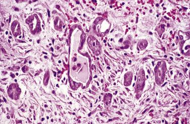 FIG. 15.13, Multilocular peritoneal inclusion cyst with mural mesothelial cells.