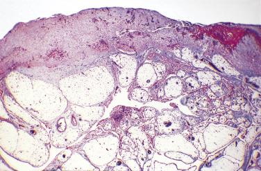 FIG. 15.15, Sclerosing peritonitis that was associated with a luteinized thecoma of the ovary. Fibrotic thickening of the omental surface and its interlobular septa can be seen. (Masson trichrome stain.)