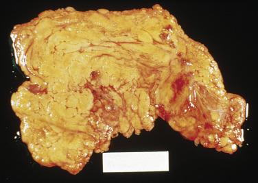 FIG. 15.16, Splenosis of omentum.