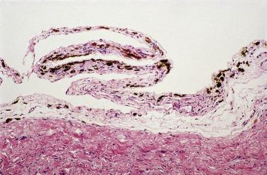 FIG. 15.17, Peritoneal melanosis.