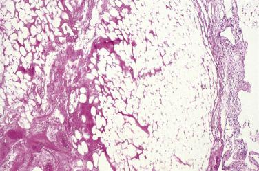 FIG. 15.18, Infarcted appendix epiploica.