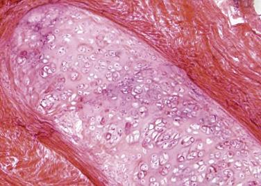 FIG. 15.19, Peritoneal cartilaginous nodule (frozen section).