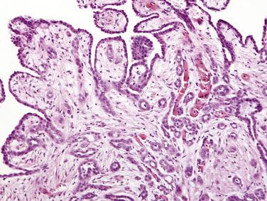 FIG. 15.20, Well-differentiated papillary mesothelioma with a tubulopapillary pattern.