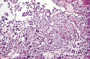 FIG. 15.2, Florid papillary mesothelial hyperplasia involving a hernia sac.