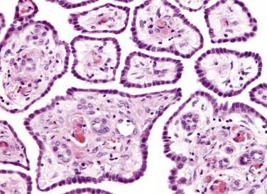 FIG. 15.21, Well-differentiated papillary mesothelioma.