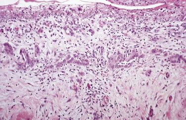 FIG. 15.3, Mesothelial hyperplasia. Note the linear arrangement of the mesothelial cells within inflamed fibrous tissue.