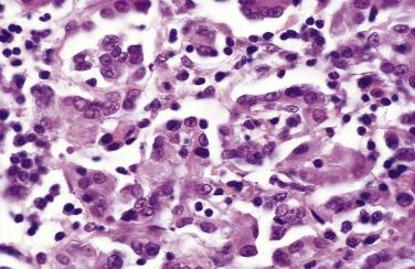 FIG. 15.4, Periovarian papillary mesothelial hyperplasia. Note mild nuclear atypia and admixed inflammatory cells.