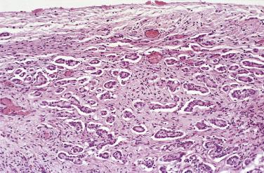 FIG. 15.5, Nests of hyperplastic mesothelial cells within ovarian stroma (the spaces surrounding the nests are retraction artifact). The hyperplastic mesothelial cells were adjacent to a mucinous borderline tumor and were misinterpreted as foci of invasion.