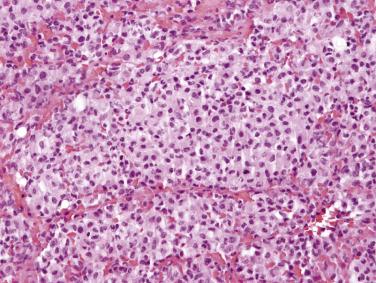 FIG. 15.6, Nodular histiocytic hyperplasia of the omentum.