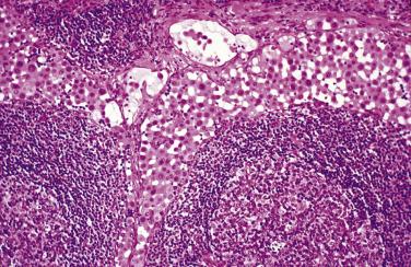 FIG. 15.7, Hyperplastic mesothelial cells within pelvic lymph node. The mesothelial cells fill the subcapsular lymphatics and sinusoids. There was associated mesothelial hyperplasia of the peritoneum.