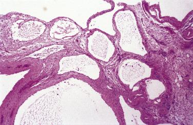 FIG. 15.10, Multilocular peritoneal inclusion cyst.