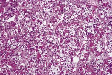 FIG. 17.1, Histology of the normal anterior pituitary. H&E staining shows the multiple cell types of the normal pituitary. Basophilic, eosinophilic, and chromophobic cells are intermixed in a single acinus.