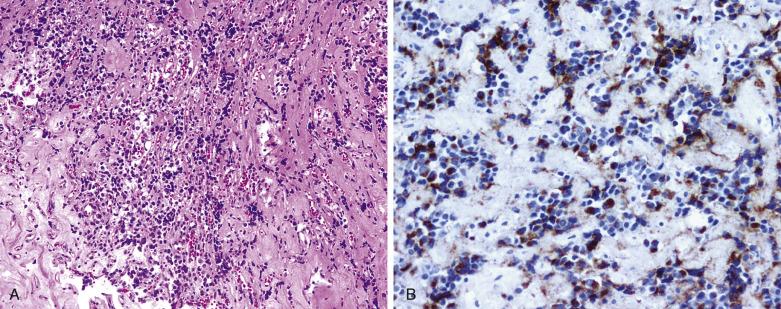 FIG. 17.11, Lactotroph adenoma. (A) Lactotroph adenoma displaying shrinkage of the tumor cells and interstitial fibrosis after medical treatment. (B) Despite treatment, PRL immunoreactivity is focally present in tumor cells.