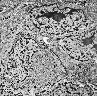 FIG. 17.12, Ultrastructure of lactotroph adenomas. Sparsely granulated lactotroph adenoma displaying prominent rough endoplasmic reticulum, Golgi complexes, and sparse secretory granules.