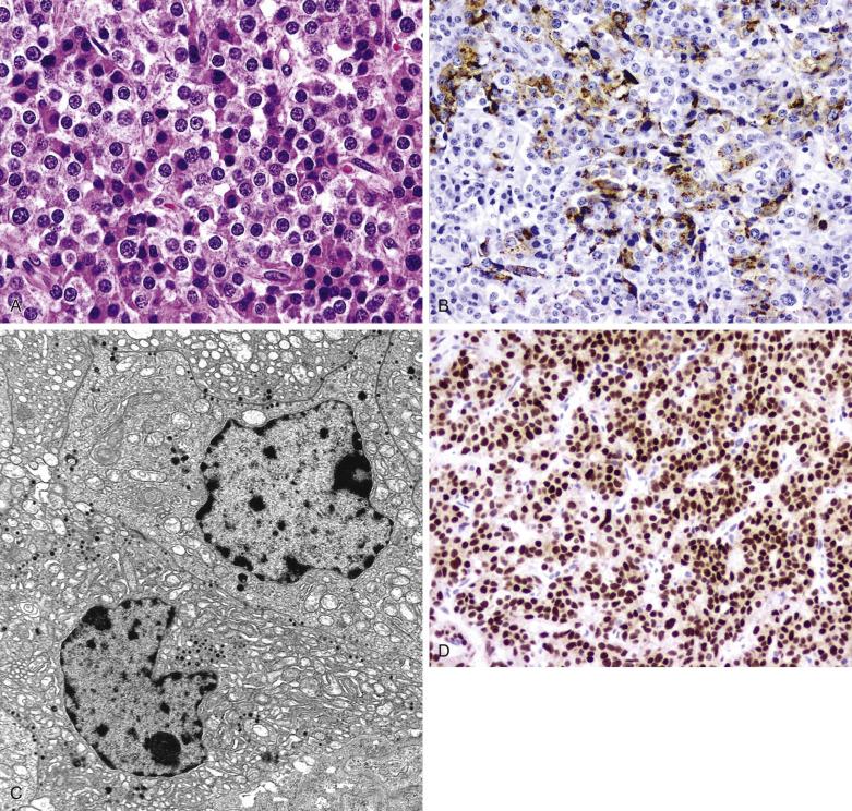FIG. 17.13, Acidophilic stem cell adenoma. (A) Acidophilic stem cell adenomas show slightly acidophilic cytoplasm with moderate granularity consistent with oncocytic change. (B) Tumor cells are immunoreactive for PRL in a more diffuse distribution than the paranuclear (Golgi) pattern seen in prolactinomas. (C) Ultrastructure reveals numerous mitochondria producing an oncocytic appearance. (D) Acidophilic stem cell adenoma shows intense nuclear expression of the transcription factor Pit-1.