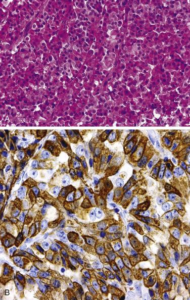 FIG. 17.14, Somatrotroph adenoma. (A) A densely granulated somatotroph adenoma showing eosinophilic, granular cytoplasm and central nucleus with prominent nucleoli. (B) Tumor shows intense and diffuse immunopositivity for GH.