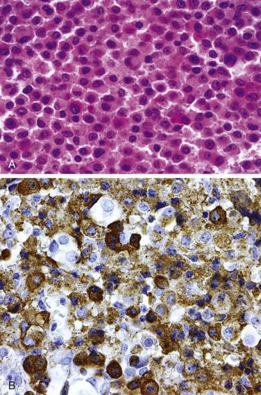 FIG. 17.15, Somatotroph adenoma. (A) A sparsely granulated somatotroph adenoma with a more chromophobic appearance showing paranuclear fibrous bodies. (B) GH immunoreactivity is typically more focal within the cell and less prominent than in densely granulated adenomas.