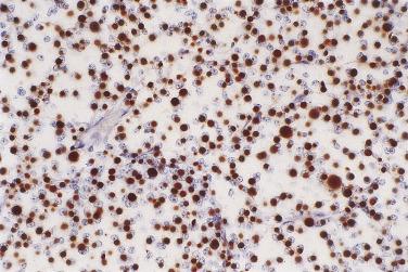 FIG. 17.16, Somatotroph adenoma. Cytokeratin immunohistochemistry highlights the paranuclear fibrous body seen in sparsely granulated tumors.