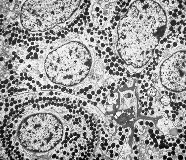 FIG. 17.17, Ultrastructure of somatotroph adenoma. A densely granulated somatotroph adenoma exhibiting well-developed organelles and abundant large secretory granules.