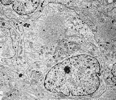 FIG. 17.18, Ultrastructure of somatotroph adenoma. A sparsely granulated somatotroph adenoma displays sparse secretory granules and the characteristic fibrous bodies.