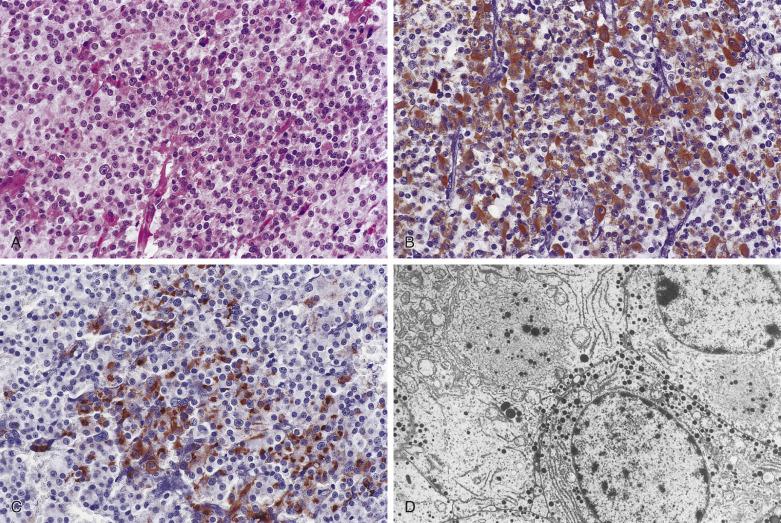 FIG. 17.19, Mixed somatotroph-lactotroph adenoma. (A) The appearance of a mixed somatotroph-lactotroph adenoma on H&E stain may be indistinguishable from a somatotroph adenoma, displaying eosinophilic or chromophobic cells. The tumor shows immunoreactivity for GH (B) and PRL (C) in distinct cell populations. (D) Ultrastructure confirms the dual cell population of this tumor composed of PRL cells (bottom) and sparsely granulated GH cells (upper). Note the fibrous body structure in the cytoplasm of the GH cell.