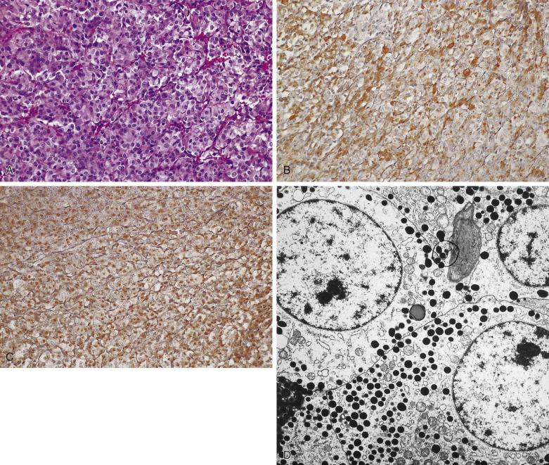 FIG. 17.20, Mammosomatotroph cell adenoma. (A) As in the mixed somatotroph-lactotroph adenomas, the histologic appearance of mammosomatotroph cell adenomas is nondistinctive. Immunohistochemistry for GH (B) and PRL (C) is demonstrated in the same cell population. (D) Ultrastructural findings in these tumors are characteristic for a single cell population exhibiting large numbers of secretory granules and misplaced exocytosis (circle).