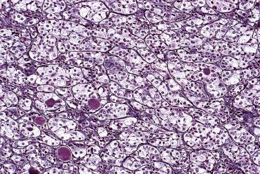 FIG. 17.2, Reticulin stain highlights the delicate reticulin stromal network surrounding the acini in the normal pituitary. Note the variation of acinar sizes.