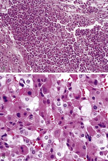 FIG. 17.21, Corticotroph adenoma. (A and B) Corticotroph adenomas are composed of large cells with angular, amphophilic cytoplasm and large pleomorphic nuclei (B). A tilelike arrangement of cells is sometimes seen.