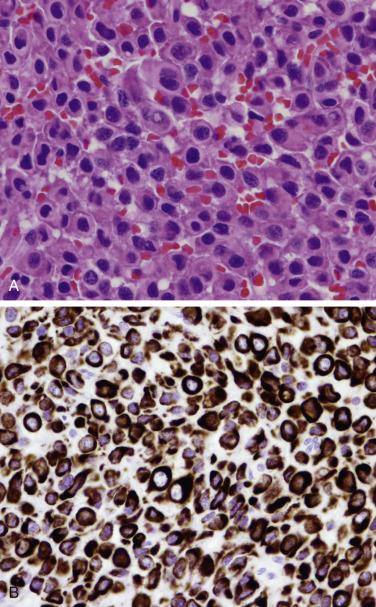 FIG. 17.22, Crooke cell adenoma. (A) Crooke cell adenomas are characteristically composed of large numbers of cells displaying Crooke hyaline change. These are characterized by the accumulation of hyaline bundles in the cytoplasm displacing the secretory granules to the periphery of the tumor cell. (B) Cytokeratin immunostain highlights Crooke changes on tumor cells.