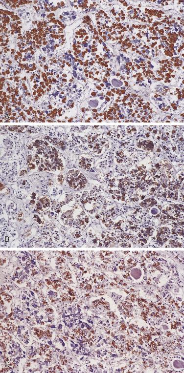 FIG. 17.3, The heterogeneous populations of cells present in single acini. (A) Growth hormone–immunoreactive cells constitute the largest population of cells in the normal pituitary. (B) Adrenocorticotropic hormone–immunoreactive cells in the normal pituitary. (C) Prolactin-immunoreactive cells in the normal pituitary.