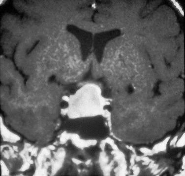 FIG. 17.4, Pituitary adenoma. T1-weighted postcontrast magnetic resonance image showing a macroadenoma compressing the optic chiasm.