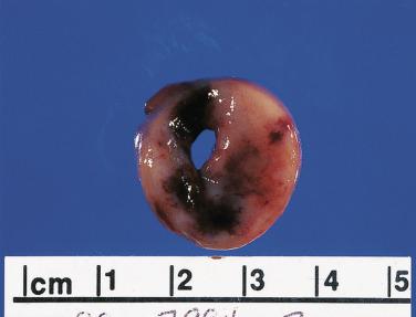 FIG. 17.5, Gross image of a macroadenoma demonstrating the soft, brownish appearance of a pituitary adenoma. Focal areas of acute hemorrhage are commonly seen as a result of operative procedures.