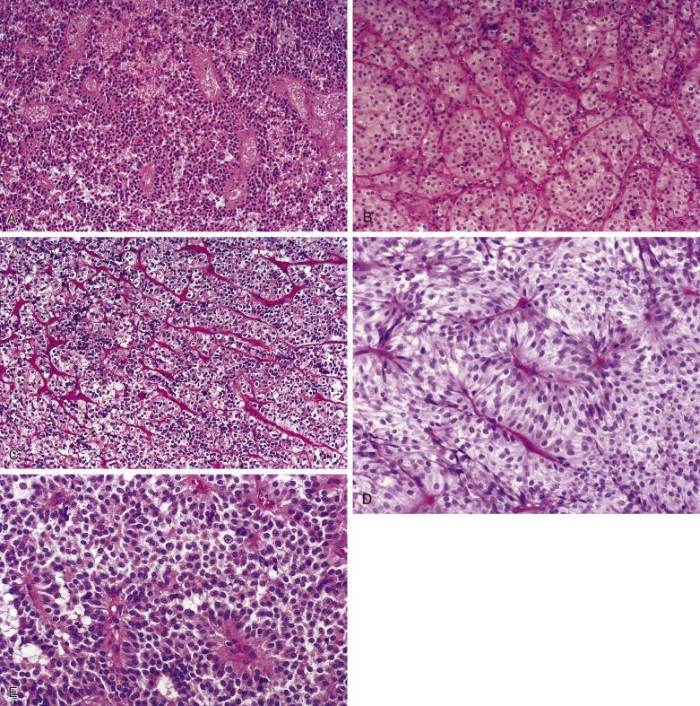 FIG. 17.6, Pituitary adenomas may display multiple histologic patterns of growth. (A) Papillary pattern. (B) Alveolar pattern. (C) Trabecular pattern. (D) Spindle cell pattern. (E) High magnification of papillary pattern of pituitary adenoma.