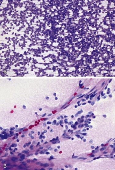 FIG. 17.7, Intraoperative preparations of pituitary adenomas. (A) Morris preparation of intraoperative smears of a pituitary adenoma shows a homogeneous population of cells within a granular background. (B) Papillary formations are easily recognized on smears.