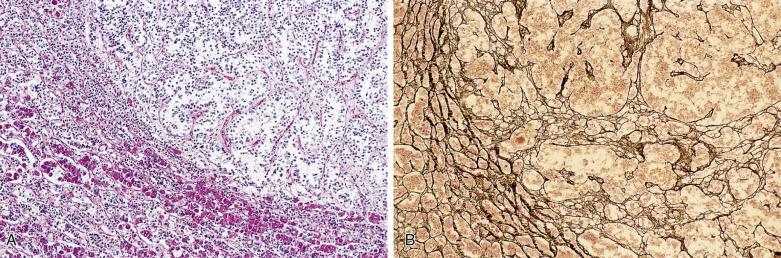 FIG. 17.8, Pituitary adenoma compressing the residual pituitary. (A) Periodic acid–Schiff stain shows the uniform population of the cells of the adenoma in relation to the normal pituitary. (B) Reticulin preparation emphasizes the dissolution of the normal reticulin network in the adenoma in comparison with the adjacent normal gland.