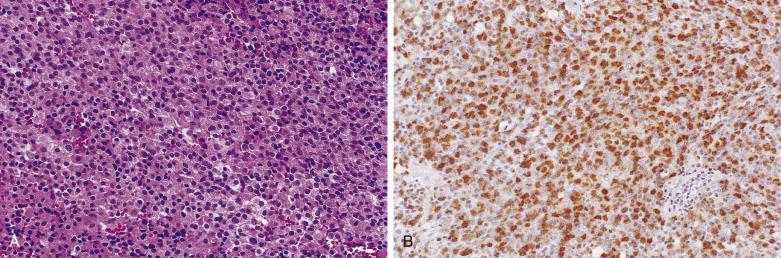 FIG. 17.9, Lactotroph adenoma. (A) Sparsely granulated lactotroph adenoma showing chromophobic cytoplasm and central nuclei with delicate chromatin. (B) PRL immunoreactivity is typically seen in a paranuclear location.