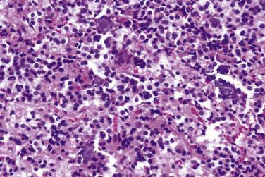 FIG. 17.10, Lactotroph adenoma. Microcalcifications are commonly seen in these tumors.