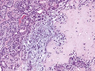 FIG. 7.11, Pleomorphic adenoma. Note the characteristic regional variation in cellularity, cell arrangement, and quantity of matrix. Chondroid matrix (hyaline cartilage) is seen in the right field , and myxoid matrix is seen in the middle field .