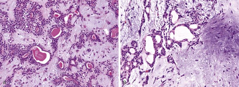 FIG. 7.12, Pleomorphic adenoma, showing the basic cytoarchitectural features diagnostic of this tumor type. (A) Tubules are lined by an inner layer of ductal cells and an outer layer of modified myoepithelial cells of variable thickness. The latter cells appear to radiate into the surrounding myxoid matrix—this pattern is not found in any other type of salivary gland tumor. (B) Anastomosed tubules of dual cell type apparently melt into a myxoid stroma.