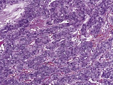 FIG. 7.13, Cellular pleomorphic adenoma. This cellular tumor shows predominance of trabeculae separated by scanty stroma.