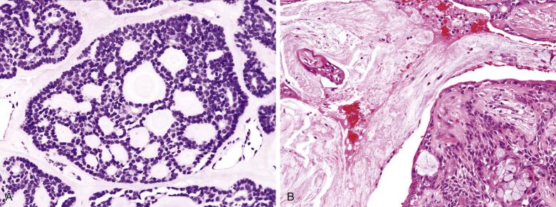 FIG. 7.14, Pleomorphic adenoma with focal areas resembling adenoid cystic carcinoma or mucoepidermoid carcinoma. (A) Cribriform structures sharply demarcated from the hyalinized stroma are present. This feature is not incompatible with a diagnosis of pleomorphic adenoma provided that the tumor is not invasive and other areas show typical cytoarchitectural features. (B) The presence of cystic structures distended with mucus, extravasation of mucus into the fibrous stroma, and mucinous cells among squamoid cells results in mimicry of low-grade mucoepidermoid carcinoma.