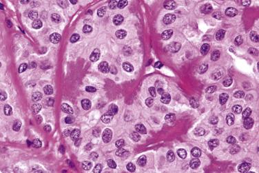 FIG. 7.16, Pleomorphic adenoma, oncocytic variant mimicking oncocytic adenoma/carcinoma. A clue to the correct diagnosis is the presence of thick, fluffy elastic fibers. In this tumor, minor areas showing typical histologic features of pleomorphic adenoma are also present (not shown).