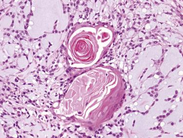 FIG. 7.17, Pleomorphic adenoma. There is a focus of squamous differentiation with keratinization amidst cords of modified myoepithelial cells lying in a myxoid matrix. Such an overt degree of squamous differentiation is practically never seen in mucoepidermoid carcinoma.