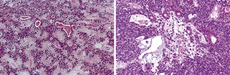 FIG. 7.19, Pleomorphic adenoma. (A) Anastomosing tubules are separated by stellate fibrillary collagen fibers. Note the corona-like appearance of the myoepithelial cells. (B) Extensive coalescence of the epithelial units creates solid sheets of cells punctuated by some glandular structures. Many of the polygonal cells represent modified myoepithelial cells, which merge into a myxoid matrix in the central field.