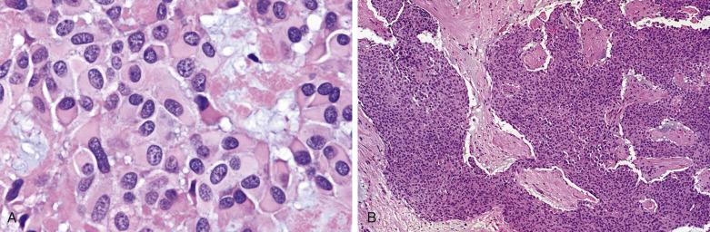 FIG. 7.20, Pleomorphic adenoma rich in plasmacytoid hyaline cells. (A) Plasmacytoid hyaline cells are typically ovoid, with eccentrically placed nuclei and abundant eosinophilic hyaline cytoplasm. They are not uncommonly dispersed in a myxoid stroma. (B) Plasmacytoid hyaline cells can form alarmingly solid sheets.