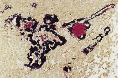 FIG. 7.23, Pleomorphic adenoma, stained with elastic van Gieson. The thick elastic fibers with fluffy outline are characteristic of pleomorphic adenoma and are rarely found in other salivary gland tumor types.