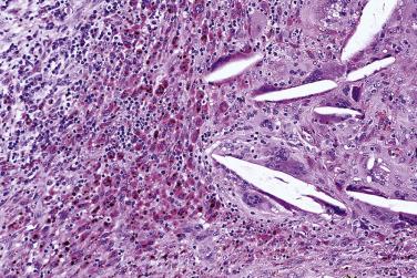 FIG. 7.24, Pleomorphic adenoma, post–fine-needle aspiration changes. Response to tissue injury takes the form of chronic inflammatory cell infiltration, siderophage accumulation, and foreign body giant cell reaction against cholesterol crystals.