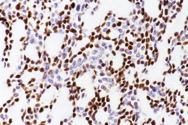 FIG. 7.27, Pleomorphic adenoma immunostained for p63. The modified myoepithelial cells (abluminal cells) are highlighted, whereas the luminal cells are negative.